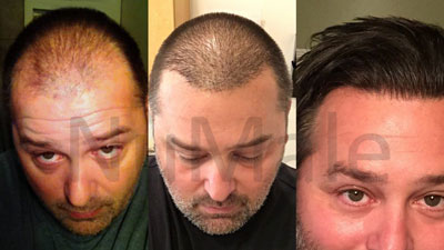 numale hair restoration